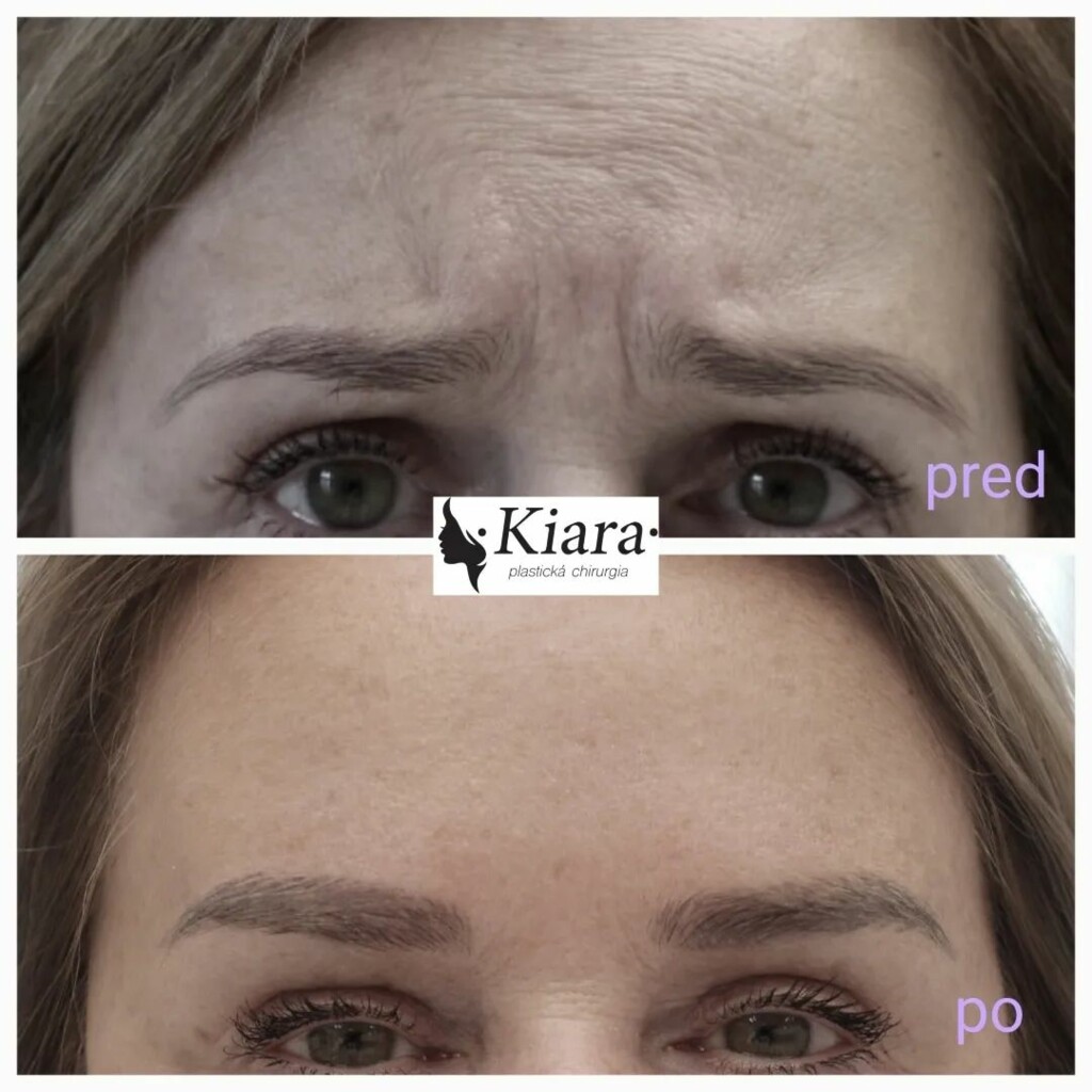 Botox-Anwendung