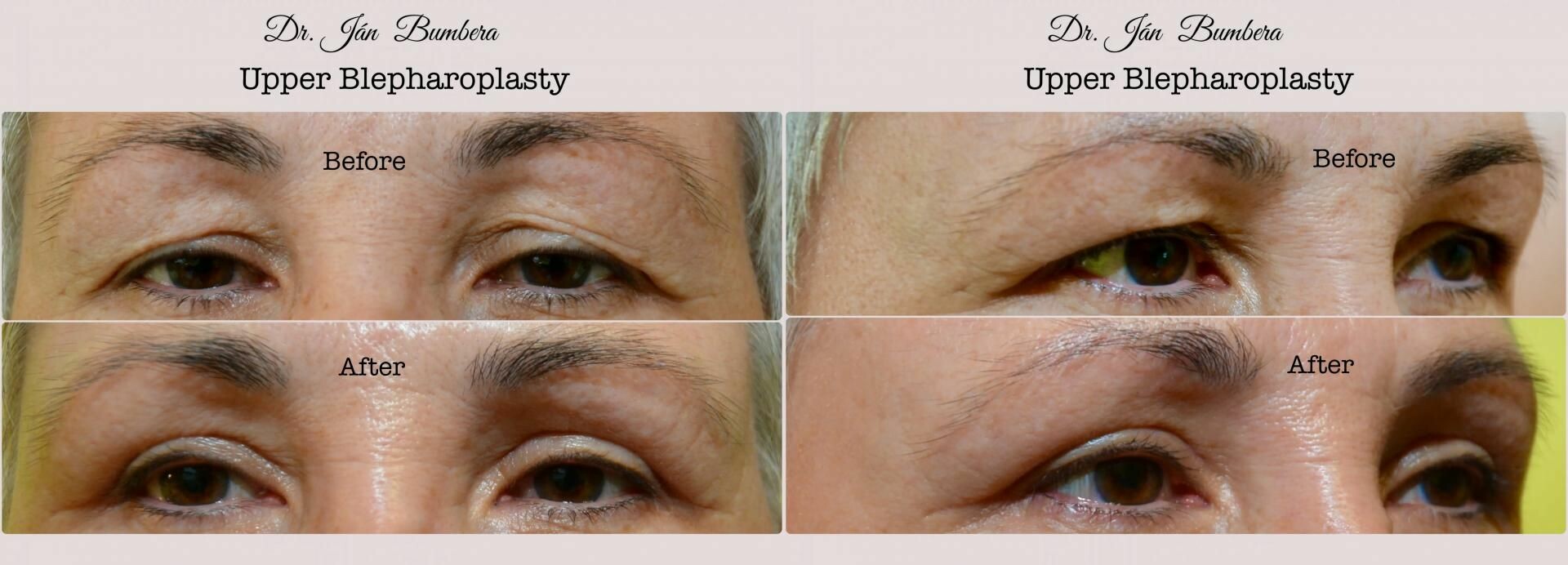 Obere Blepharoplastik