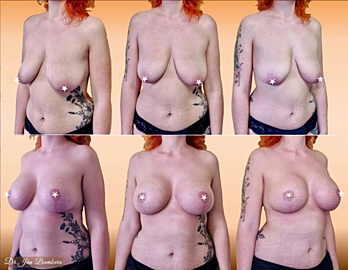 Korrektur von Brustasymmetrien und -vergrößerungen durch Implantate