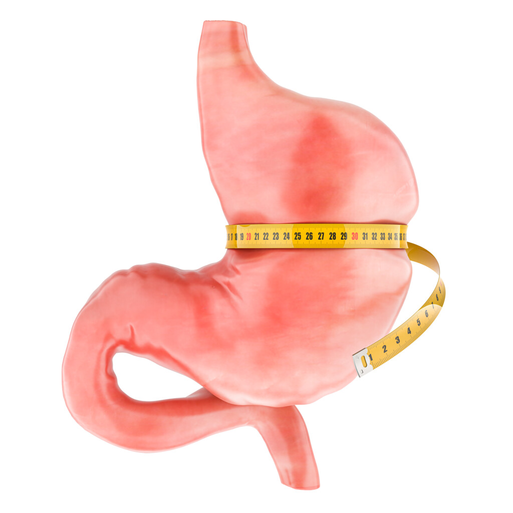 Magenverkleinerung (bariatrische Chirurgie)